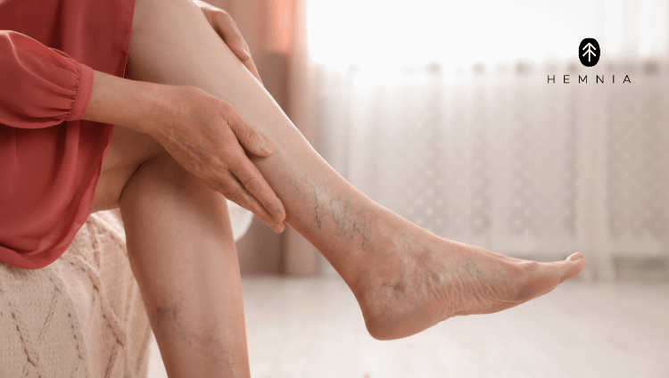 Close-up of a woman's legs with visible varicose veins, illustrating the causes, symptoms, and treatment of varicose veins