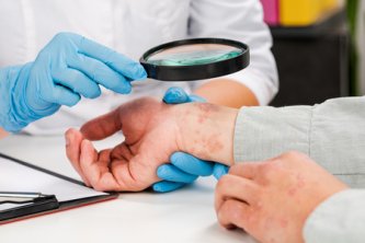 CBD és pikkelysömör - hogyan segíthet a kannabidiol