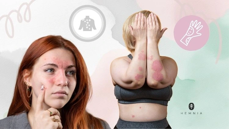 Divas sievietes ar atopisko ekzēmu; Hemnia logotips apakšējā labajā stūrī